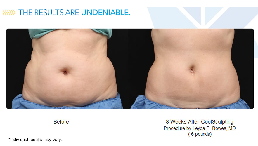 coolsculpt-results-may-vary